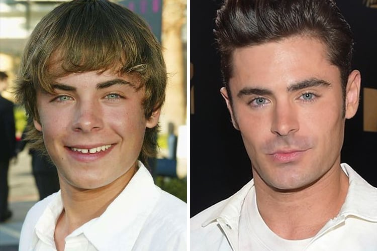 plastic-surgery-zac-efron